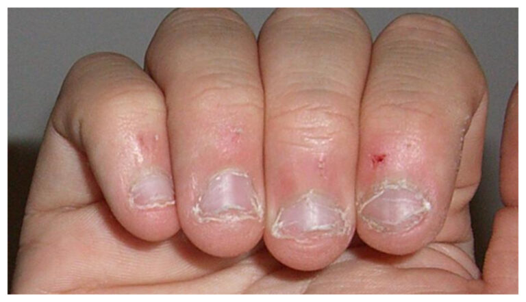 ¿Que llevá a morderse las uñas?