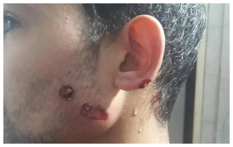 Salió a comprar y la policía le disparó con balas de goma por violar la cuarentena