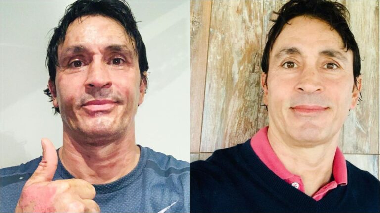 Sebastián Estevanez mostró su recuperación después del accidente doméstico que sufrió