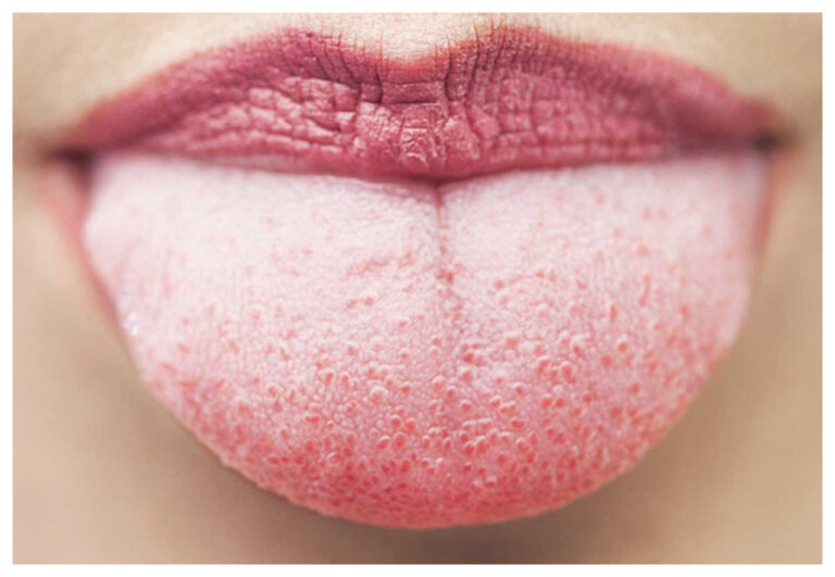 ¿Por qué a veces tenemos la lengua blanca?
