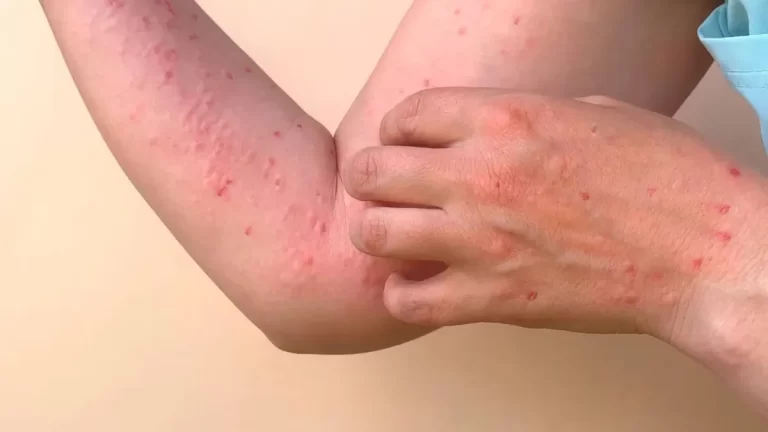 Viruela del mono: confirman el primer caso en Argentina y llaman a la calma